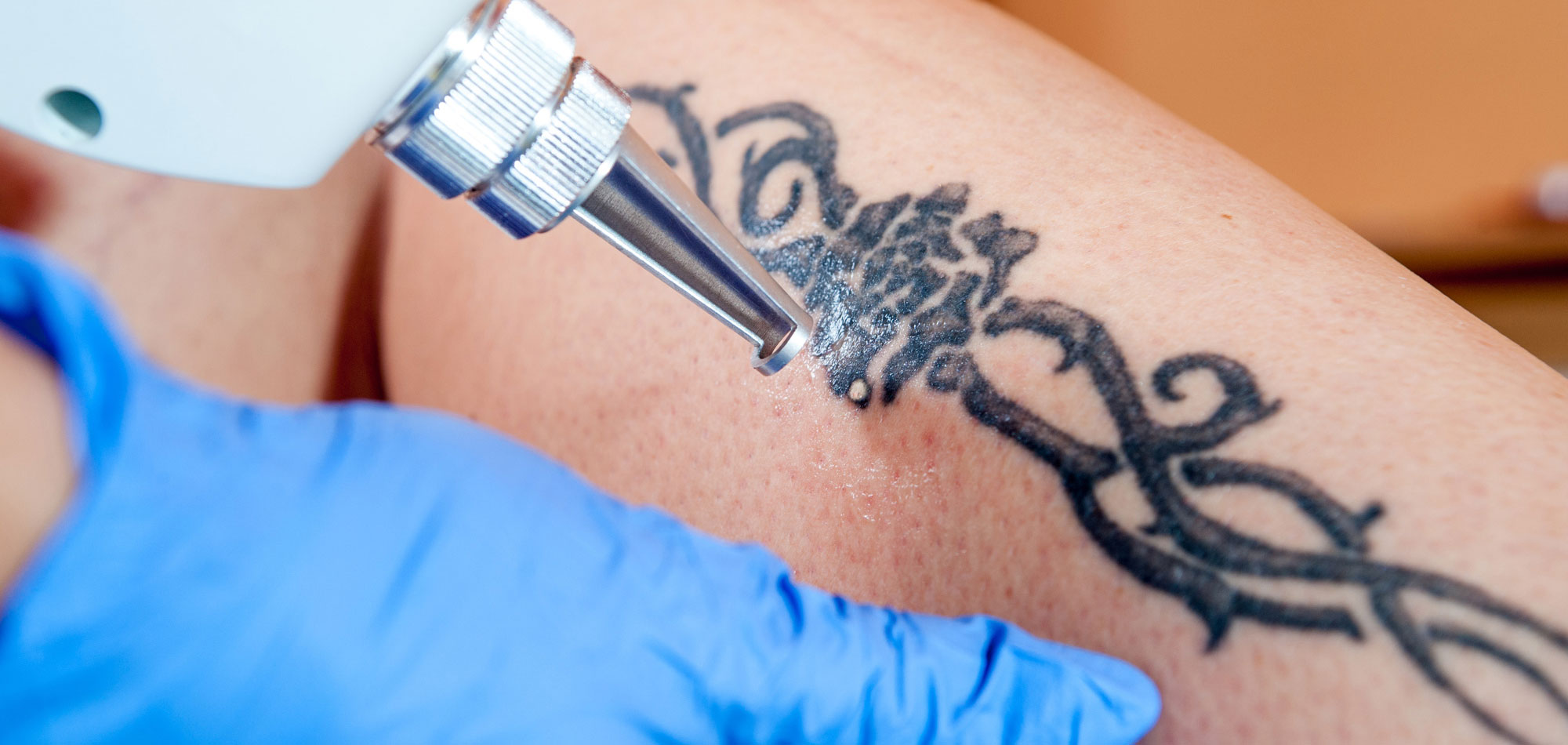 Tattooentfernung mit modernster Lasertechnologie